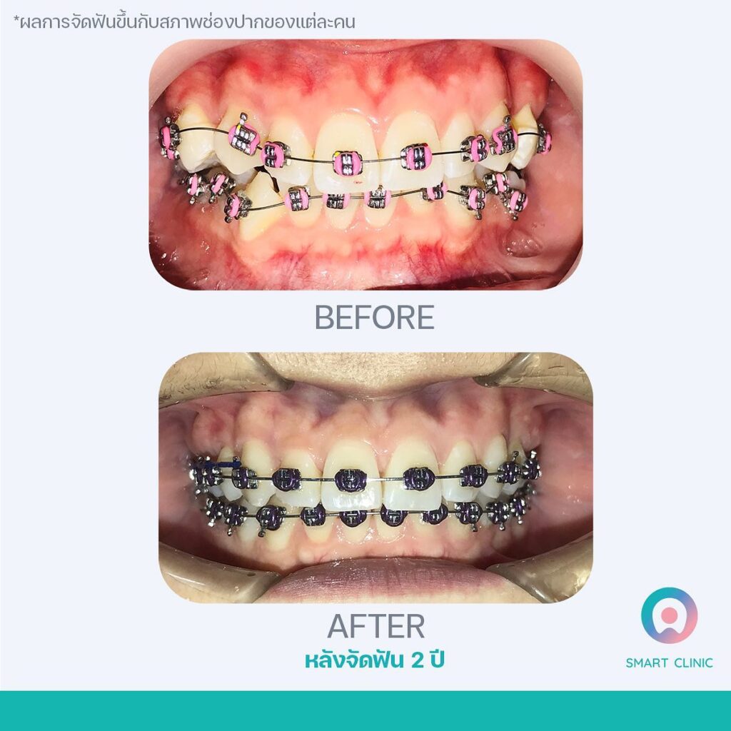 รีวิวจัดฟัน